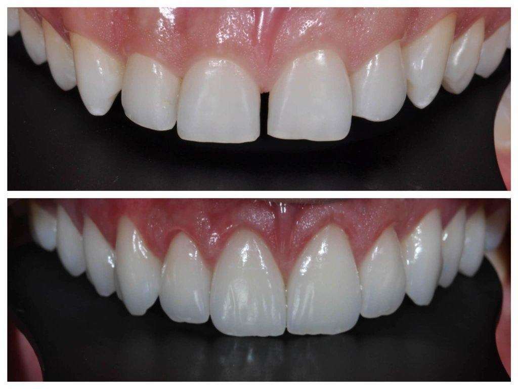 Facetas Dentárias